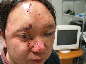 Der technische Leiter von The Epoch Times, Dr. Peter Yuan Li, trug bei einem Überfall erhebliche Wunden im Gesicht davon (