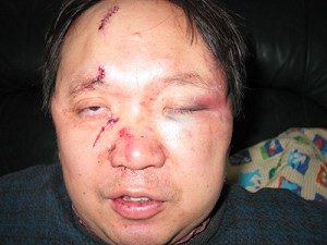 Die Wunden stammen von einem Überfall auf  Dr. Li in seiner eigenen Wohnung und mussten im Krankenhaus mit 15 Stichen genäht werden. (