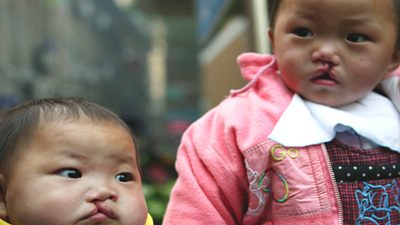 Birth Defects on the Rise in China