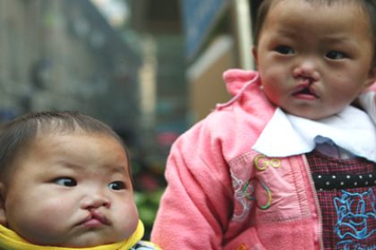 Birth Defects on the Rise in China