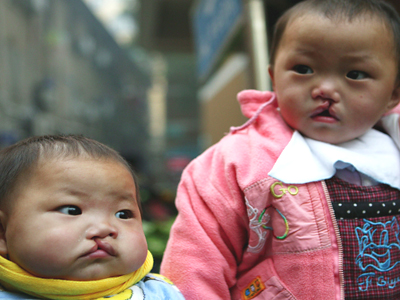 Birth Defects on the Rise in China