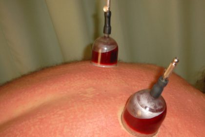 Wirksamkeit der Schmerztherapie durch Schröpfen belegt