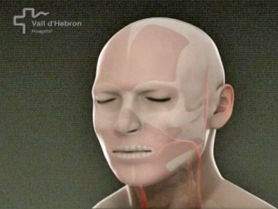 Spain: First Face Transplant Completed