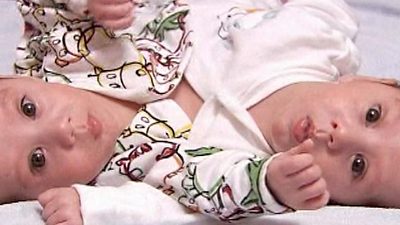 London: Separated Twins Go Home After Successful Surgery