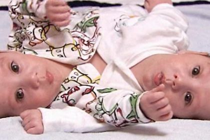 London: Separated Twins Go Home After Successful Surgery