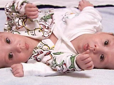 London: Separated Twins Go Home After Successful Surgery