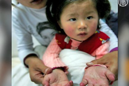 China: Ausbruch der Hand-Fuß-Mund-Krankheit