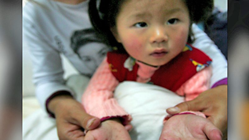 China: Ausbruch der Hand-Fuß-Mund-Krankheit