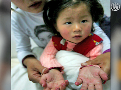 China: Ausbruch der Hand-Fuß-Mund-Krankheit