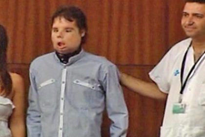 Barcelona: Worlds First Full Face Transplantee Goes Public