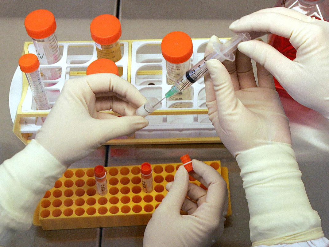 Zweiter HIV-Patient nach Stammzellen-Transplantation virenfrei