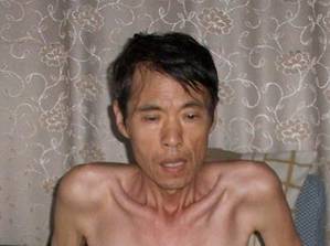 Eine Woche vor seinem Tod wurden erschreckende Bilder von Yunping Zhang gemacht. Er praktizierte Falun Gong und wurde in Chinas Arbeitslagern gefoltert. Er starb an den Folgen der Folter am 6. September 2010.