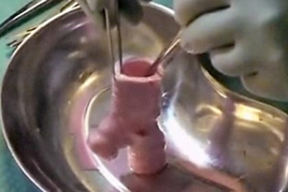 First Successful Transplant of Trachea Made of Stem Cells