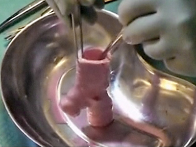 First Successful Transplant of Trachea Made of Stem Cells