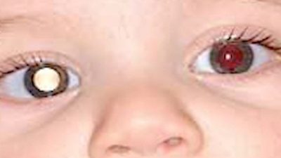 Israeli Doctors Work to Save Toddlers‘ Eye