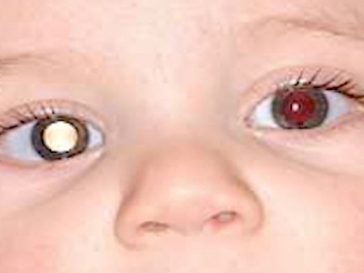 Israeli Doctors Work to Save Toddlers‘ Eye