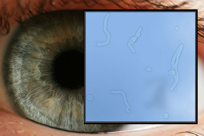 Sind „Staub-Teilchen“, die auf der Augenlinse schwimmen, normal?