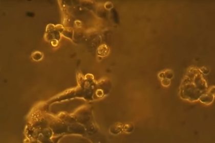Im Video: So effektiv killt GcMAF Krebszellen