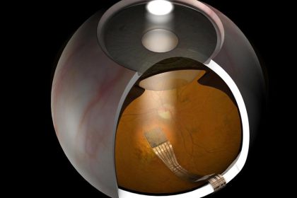 Blinde sehen lassen – Netzhaut-Chips sollen besser werden