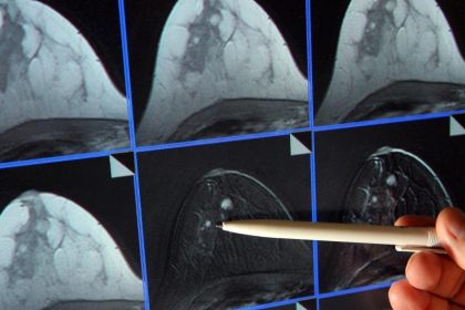 Keine Chemo, kein Krebs: Neue Behandlung vernichtet Anzeichen von Brustkrebs in 11 Tagen