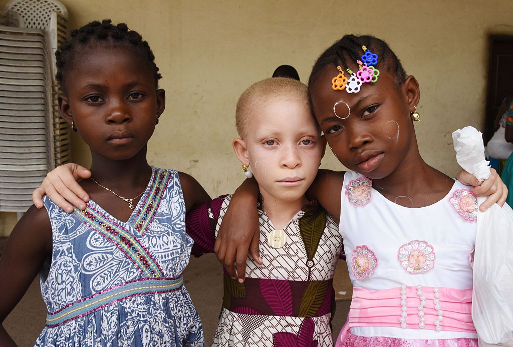 Afrikanische Albinos tragen ihren ersten Schönheitswettbewerb aus