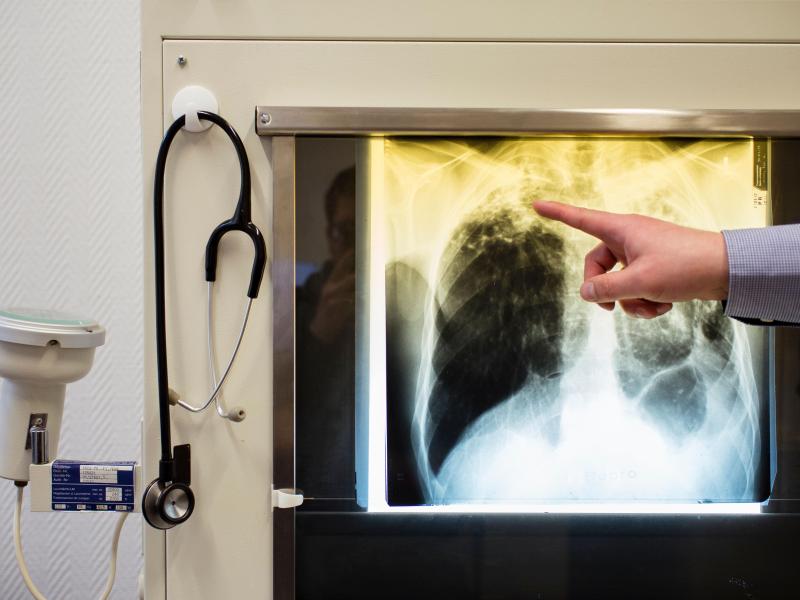 Eingewanderte Krankheiten stellen Ärzte vor Herausforderungen: Tuberkulose, Krätze und Co.