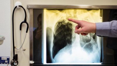 Neuer resistenter Tuberkuloseerreger bei Asylbewerbern entdeckt – Europaweites Alarmsystem aufgebaut