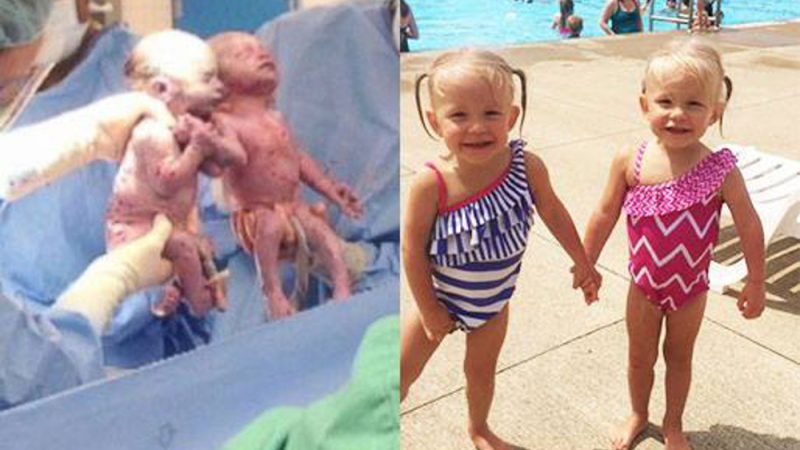 Kaiserschnitt-Zwillinge zeigen Sekunden nach ihrer Geburt unglaubliche Verbundenheit