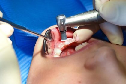 Kein Amalgam mehr für Kinder und Schwangere in der EU