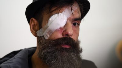 „Ich werde mein Auge verlieren“ – Gelbwesten-Vertreter Rodriguez von Gummigeschoss der Polizei getroffen