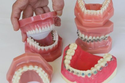 Debatte um Kieferorthopädie – Was bringen Zahnspangen?