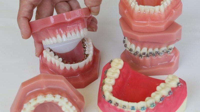 Debatte um Kieferorthopädie – Was bringen Zahnspangen?
