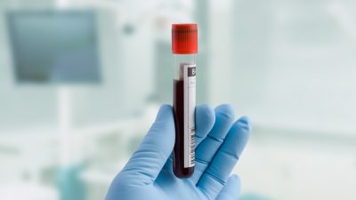 Medizinischer Durchbruch in Deutschland: Erster Blut-Test erkennt zuverlässig Brustkrebs