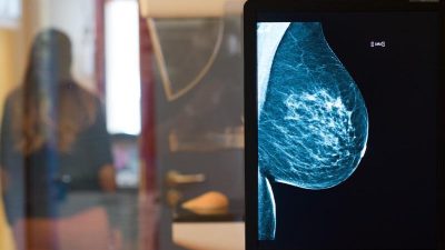 Rückgang bei im Krankenhaus behandelten Brustkrebs-Fällen