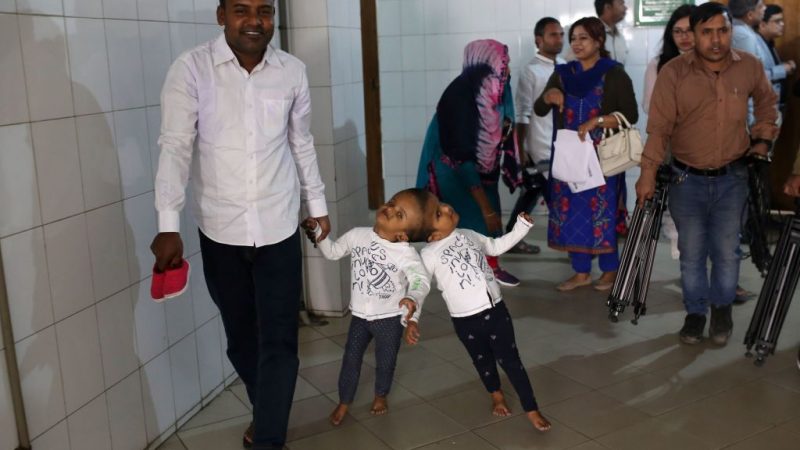 Ungarische Ärzte trennen erfolgreich siamesische Zwillinge aus Bangladesch