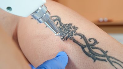 Tattoo-Entfernung bald echter Luxus? Neuregelungen machen Unternehmern und Tattoo-Träger zu schaffen