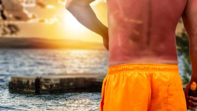 Sonnenbrandgefahr am Wochenende – UV-Strahlung hat nichts mit Temperaturen zu tun