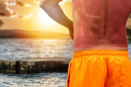Sonnenbrandgefahr am Wochenende – UV-Strahlung hat nichts mit Temperaturen zu tun