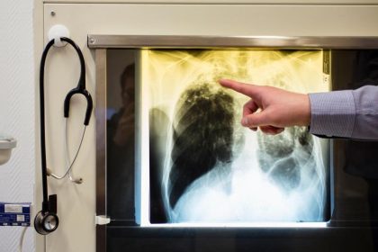 Südafrika startet klinische Studie gegen Covid-19 mit Tuberkulose-Impfstoff