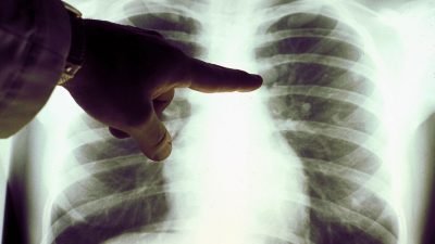 China meldet erstes Todesopfer durch mysteriöse Lungenkrankheit