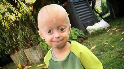 Schicksalsschlag Progerie – Eine Familie kämpft für Luke (5): „Wer ihn kennt, macht ihn nicht fertig“