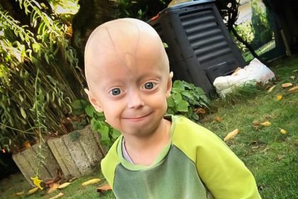 Schicksalsschlag Progerie – Eine Familie kämpft für Luke (5): “Wer ihn kennt, macht ihn nicht fertig”
