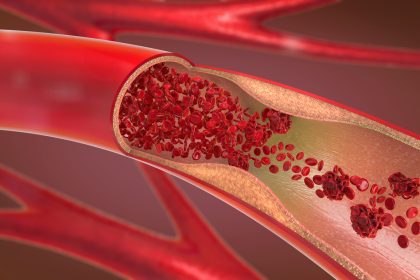 Tödliche AstraZeneca-Thrombosen: Deutscher Forscher entwickelt Test- und Behandlungsmethode