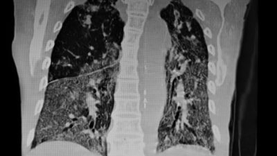 Long-COVID-Symptome teils auf chronische Lungenerkrankung zurückzuführen