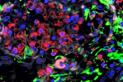 Wie das Coronavirus die Lunge zerstört