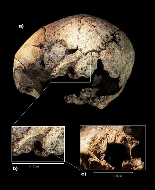 Mit Trepanation gegen Mittelohrentzündung