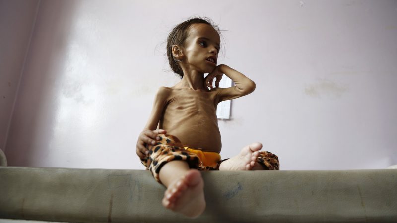 Ein unterernährtes Mädchen Bett in einem Krankenhaus in Jemens Hauptstadt Sanaa. Das Land im Süden der Arabischen Halbinsel wird im Report in die Kategorie «Katastrophe» eingeordnet.