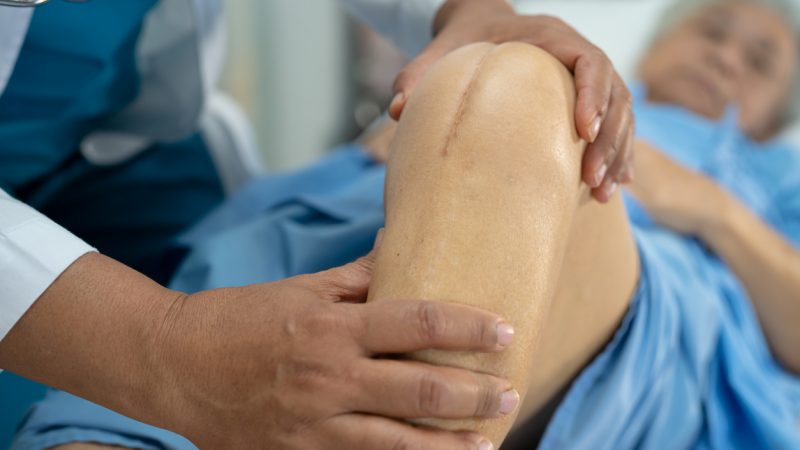 Therapie nicht ausgereizt – jeder zehnte Knieersatz ist vermeidbar