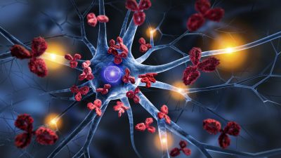 Alzheimer – Ist Eisenüberschuss im Gehirn potenzieller Auslöser?