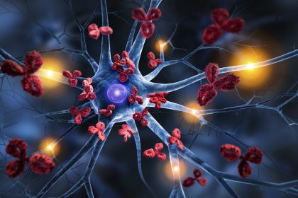 Alzheimer – Ist Eisenüberschuss im Gehirn potenzieller Auslöser?